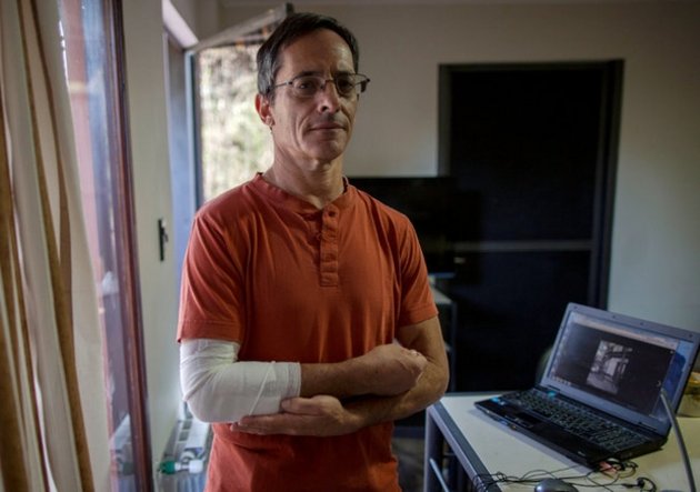Mike Silverman spent two nights in the hospital after being attacked by his Airbnb host's Rottweiler. Photo: Anibal Adrian Greco for The New York Times